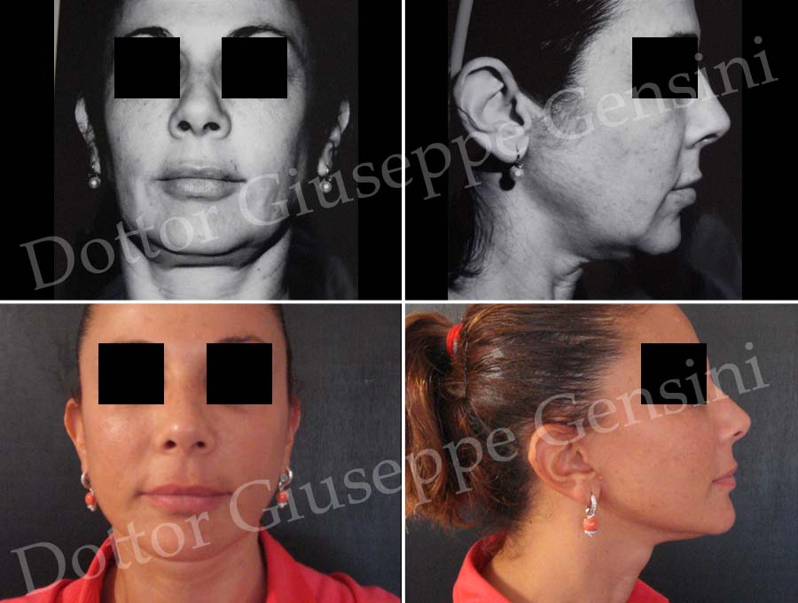 Dottor Giuseppe Gensini Chirurgo plastico - Lifting viso