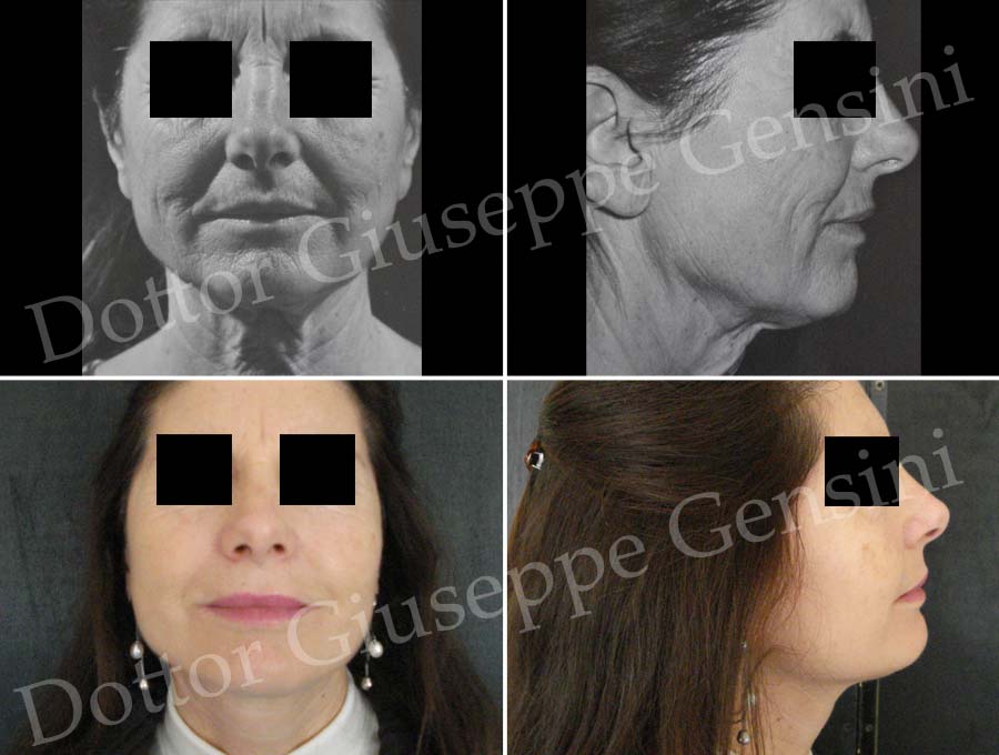 Dottor Giuseppe Gensini Chirurgo plastico - Lifting viso